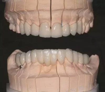 All-ceramic-crowns-and-2-implants-4