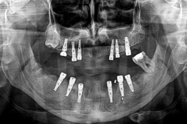 All-on-6-Implant-Supported-Fixed-Zirconia-Bridges-Upper-Lower-2-1-1